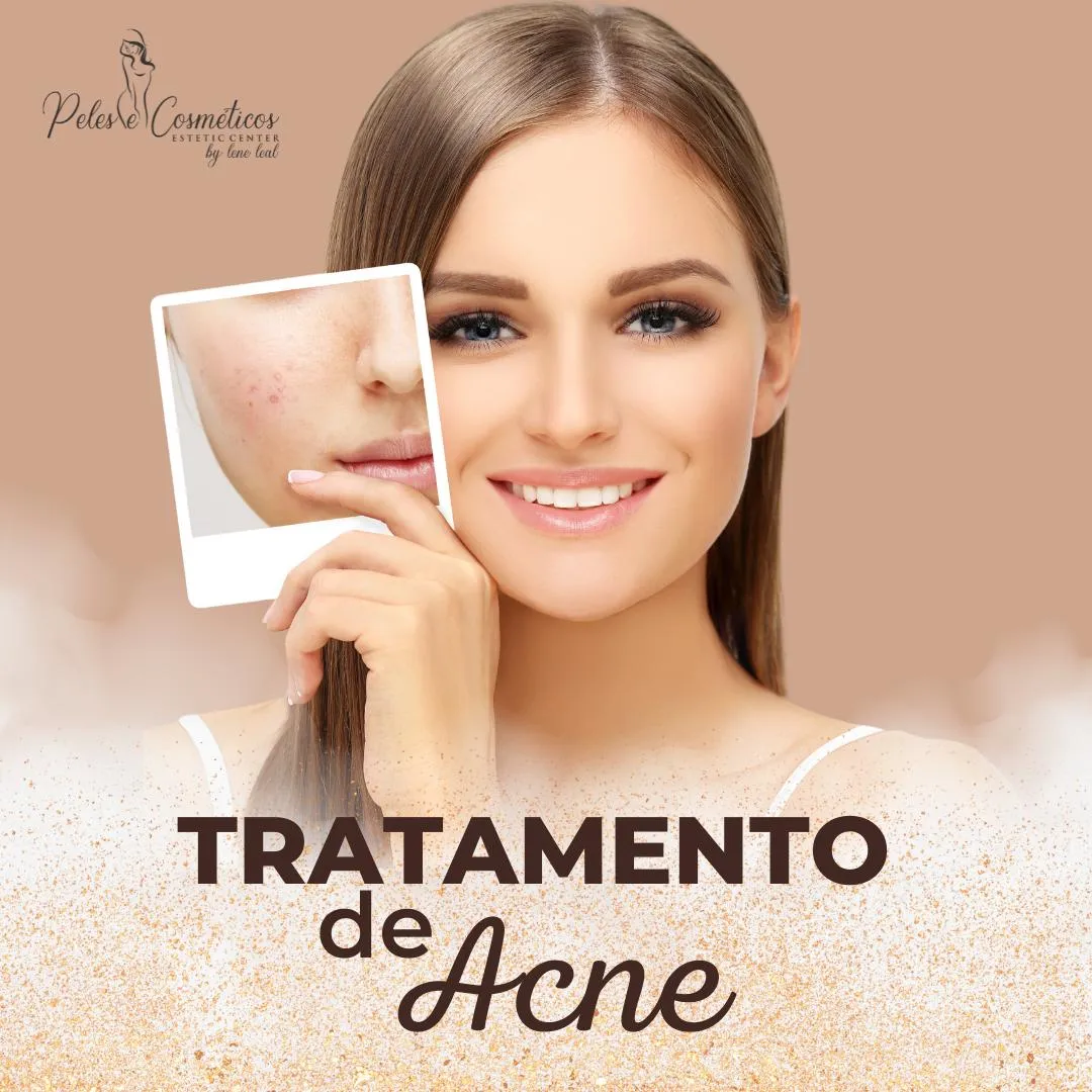 tratamento-de-acne