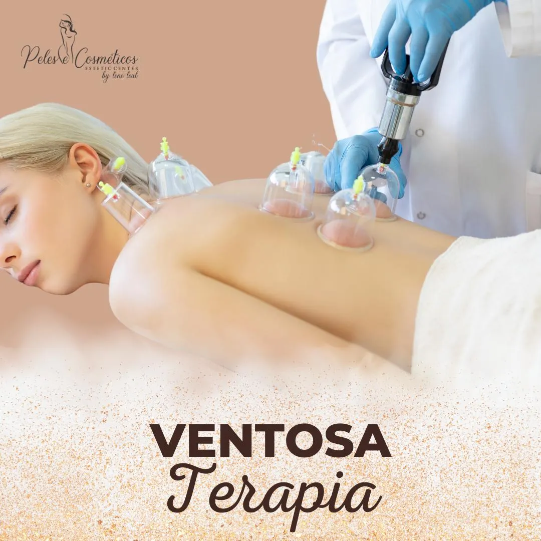 ventosa-terapia